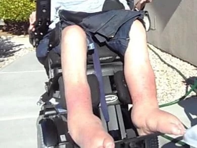 Going Further Than Elevated Legrests for Oedema in MS Patients